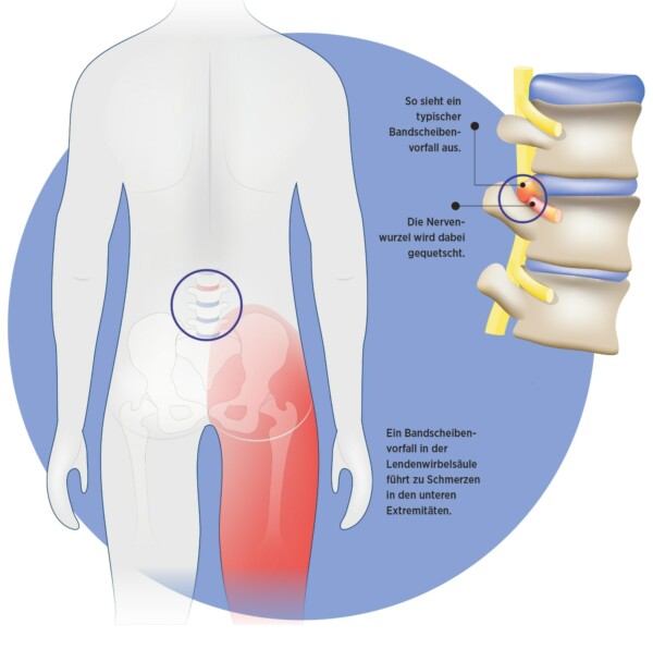 Behandlung von Beschwerden am Ischiasnerv Klinikum Braunschweig